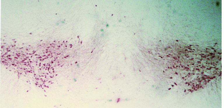 Nutrition & Parkinson’s disease: is there a link?