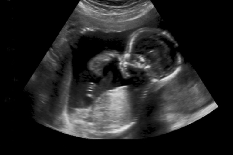 Obesity and overweight during pregnancy reduces cord blood hepcidin