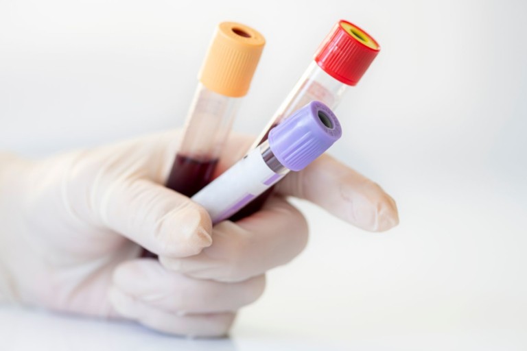 Sugar sweetened beverage consumption promotes dyslipidemia in adults